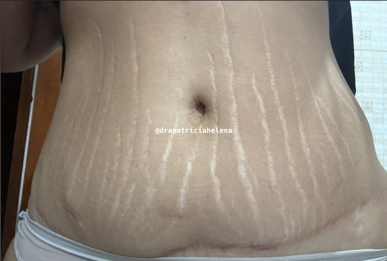 Estrias abdominais antes do Protocolo PBRC — Luminnoz