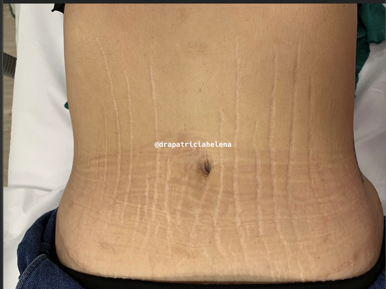Estrias abdominais após o Protocolo PBRC — Luminnoz