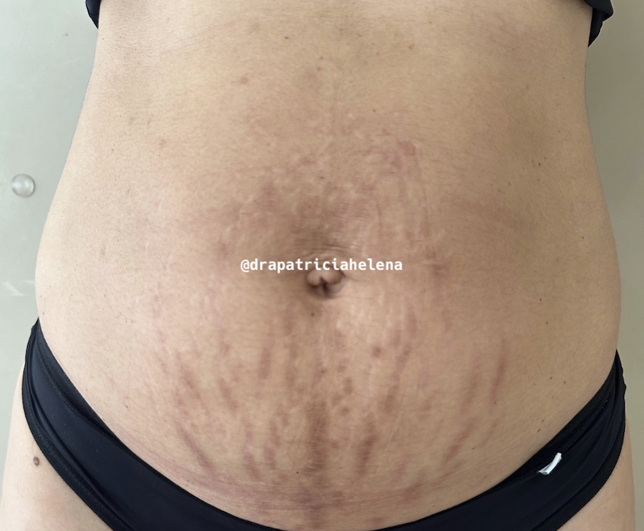 Estrias abdominais antes do Protocolo PBRC — Luminnoz