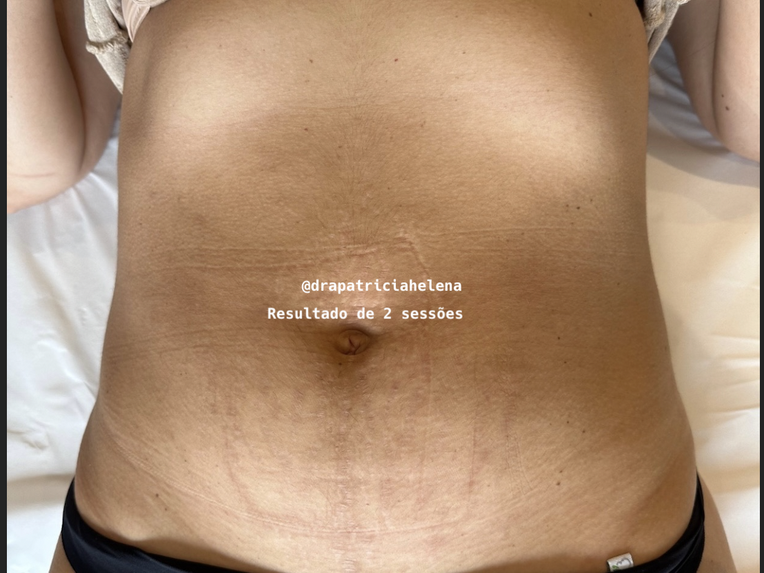Estrias abdominais após o Protocolo PBRC — Luminnoz