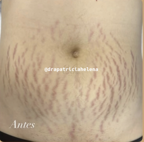 Estrias abdominais antes do Protocolo PBRC — Luminnoz