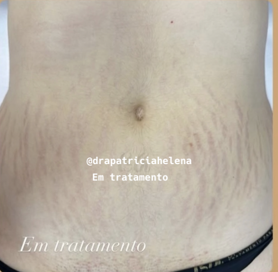 Estrias abdominais após o Protocolo PBRC — Luminnoz