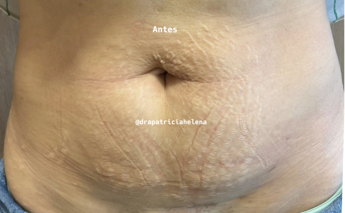 Estrias abdominais antes do Protocolo PBRC — Luminnoz