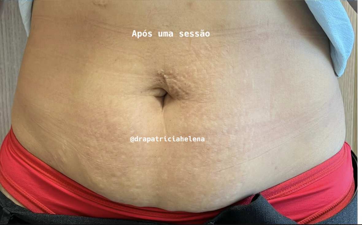 Estrias abdominais após o Protocolo PBRC — Luminnoz