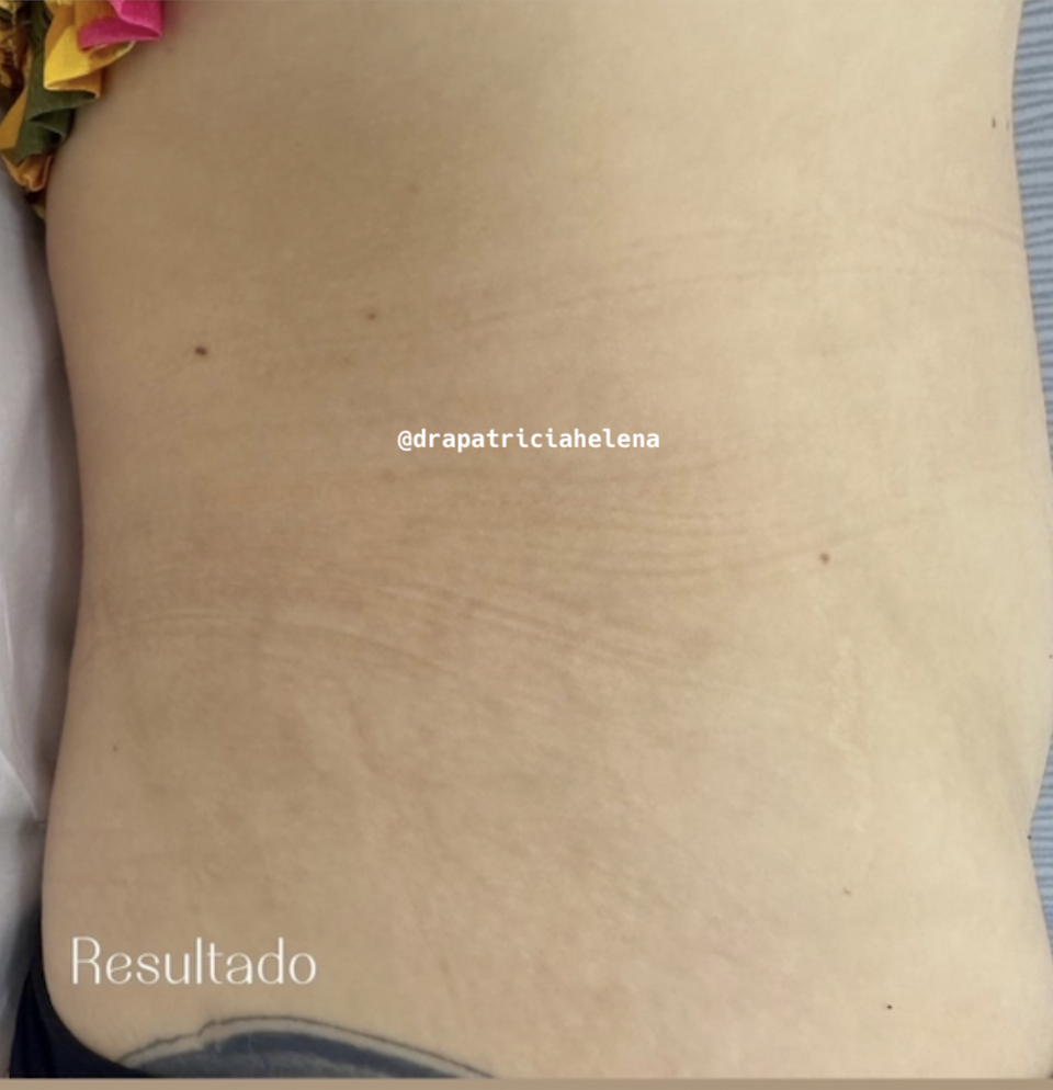 Estrias na costela após o Protocolo PBRC — Luminnoz