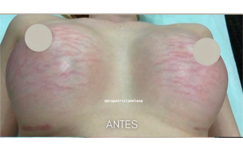 Estrias nos seios antes do Protocolo PBRC — Luminnoz